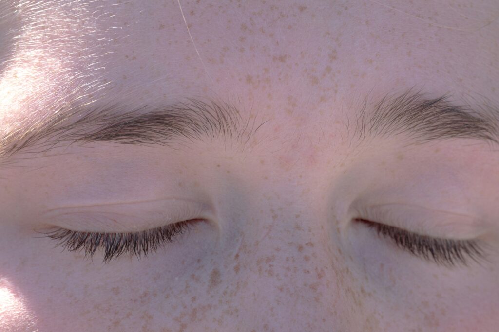 hyperpigmentation clinic birmingham - hyperpigmentation clinic birmingham