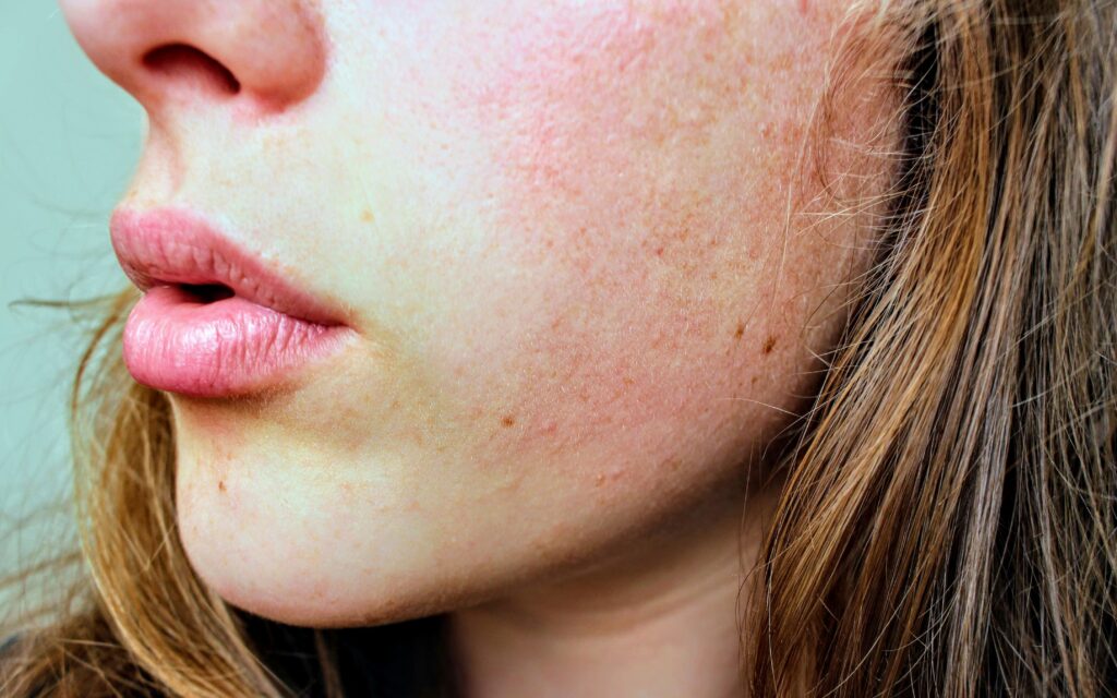 skin treatment birmingham - Woman-With-Skin-Conition-Rosacea