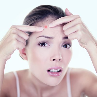 Acne treatment - Acne pimple skin blemish spot