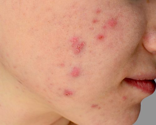 acne facial birmingham - Acne skin