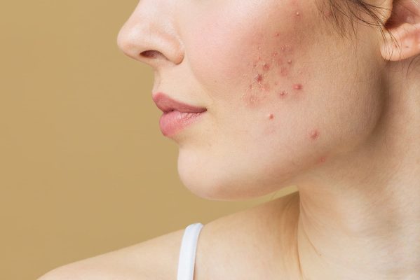 acne treatment clinic - young woman with bad skin