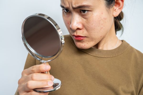 acne woman