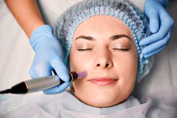 cosmetic skin care windsor - dermapen during skincare procedure
