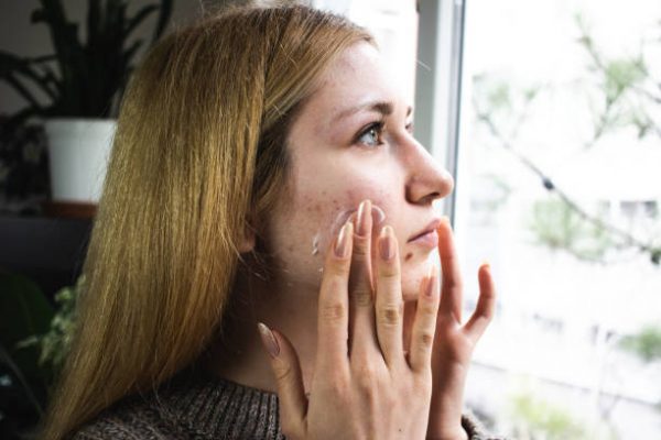 hair and skin clinic birmingham - acne