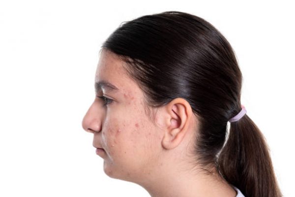 acne scar treatment birmingham - acne scar