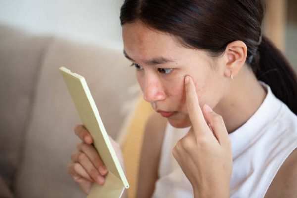 Portrait of Asian woman worry about her face when she saw the problem of acne inflammation occur on her face by a mini mirror.