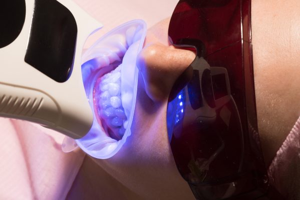 laser teeth whitening slough - teeth whitening