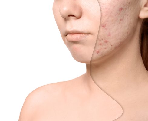 skin clinic Birmingham - woman before and after acne treatment